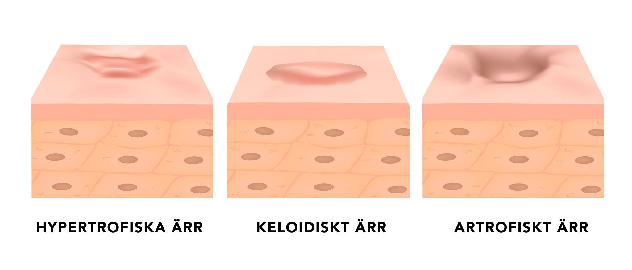 Image of Ärr behandling: Keloid ärr, artrofiska ärr & upphöjda ärr. Lär dig allt! 