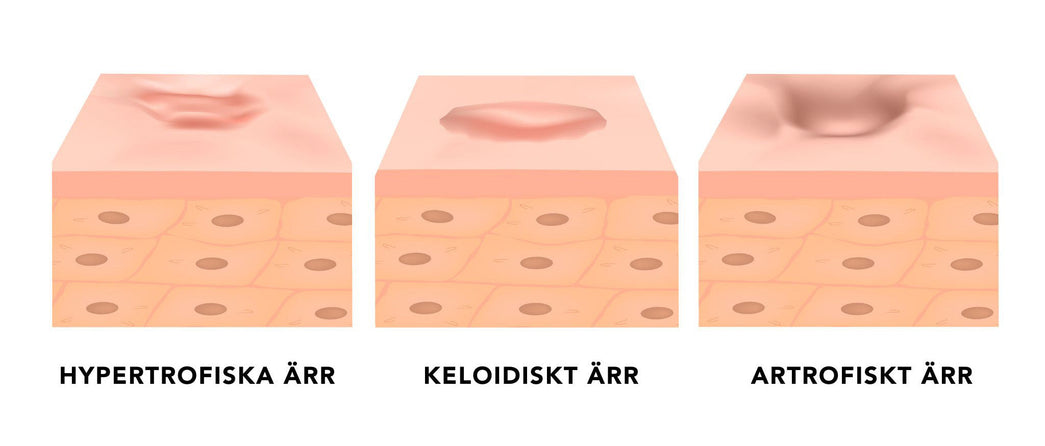 Ärr behandling: Keloid ärr, artrofiska ärr & upphöjda ärr. Lär dig allt! 