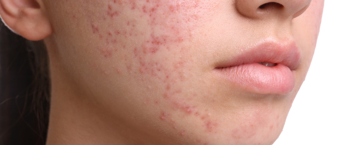 Image of Guide: Akne i tonåren