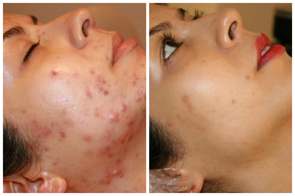 Microneedling före efter bilder | Skinroller.co