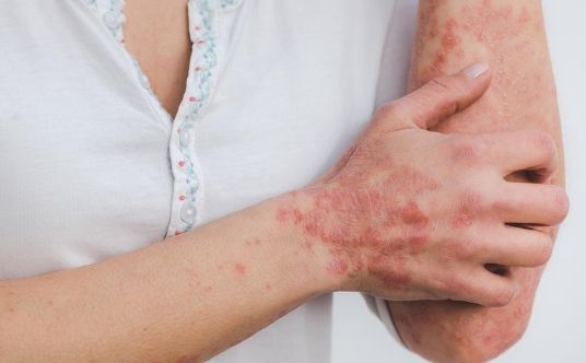 Psoriasis vad är det?_ behandling