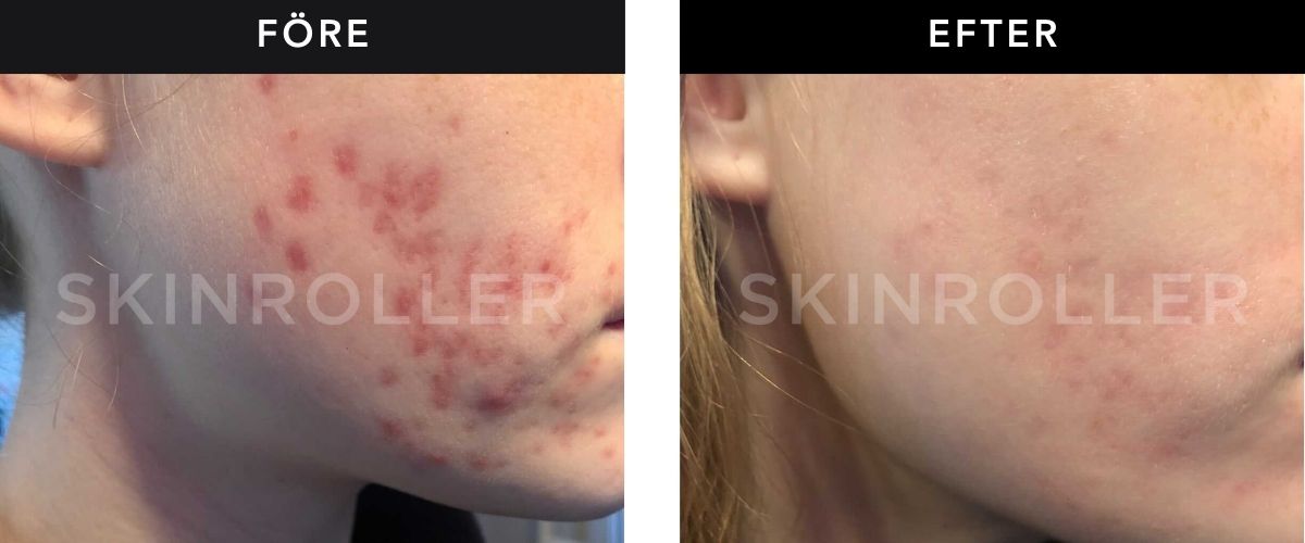 Image of Retinol före och efter