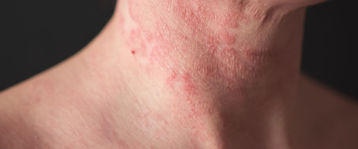 Image of Vad är Perioral Dermatit?