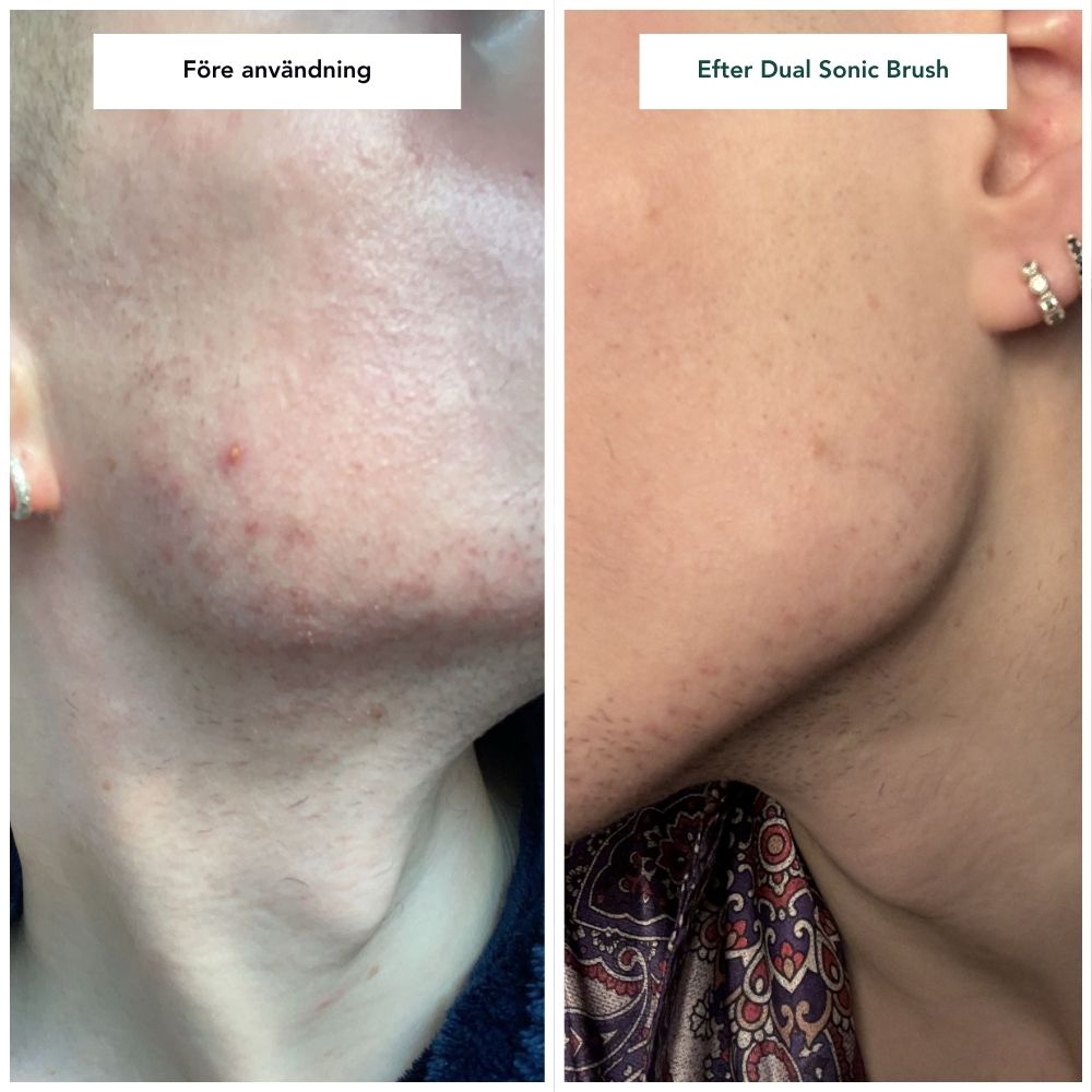 Image of 2-in-1 Dual Sonic Cleansing Brush - Ansiktsrengöringsborste