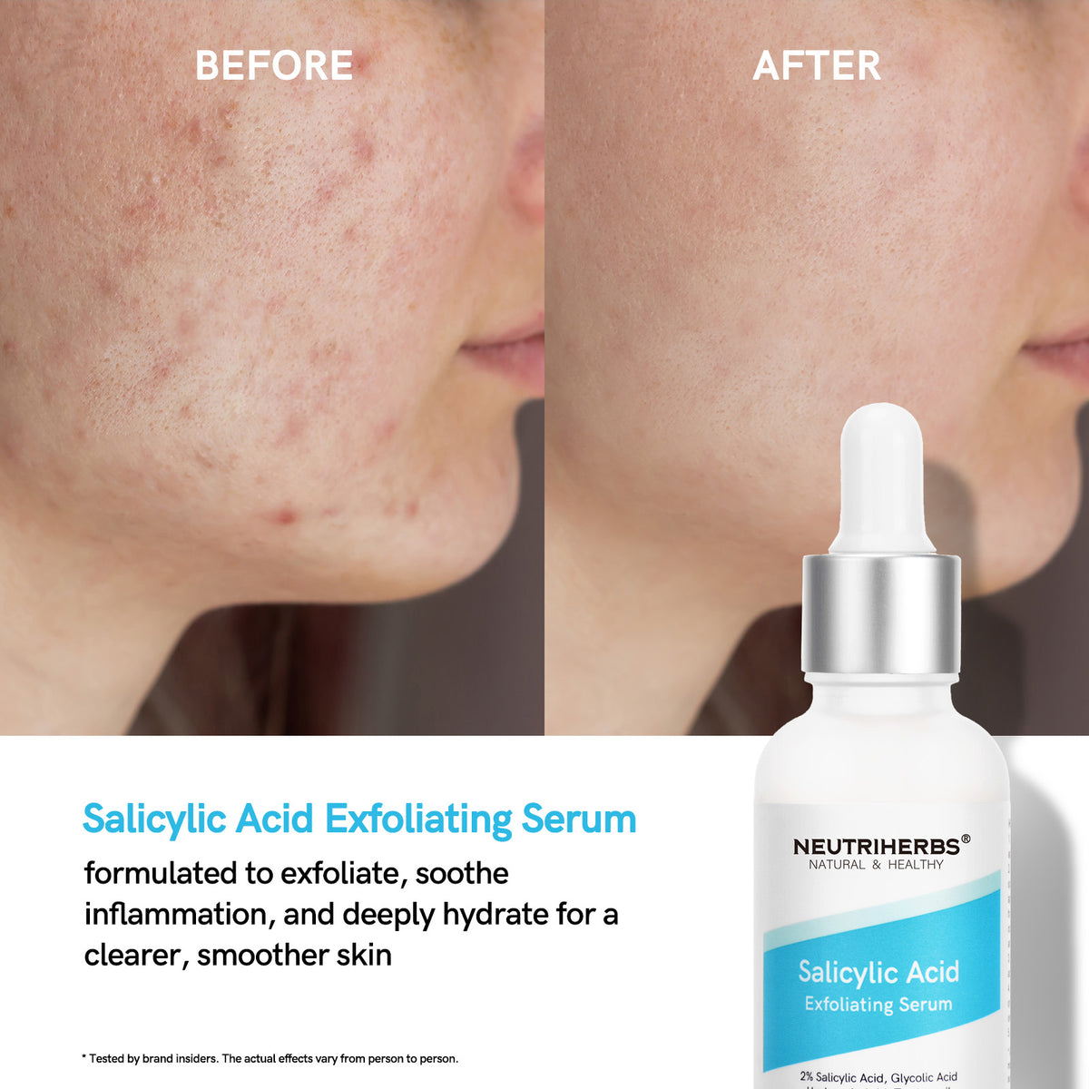 Salicylic Acid (BHA syra) Serum - 30 ml - Neutriherbs