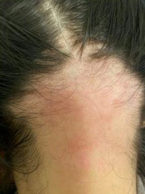 Håravfall / Alopecia — före