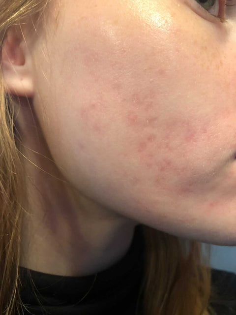 Jämnare, klarare hy efter 1,5 års användning — efter