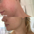 Före och efter resultat med Brilliant 10% Niacinamide + Zinc serum