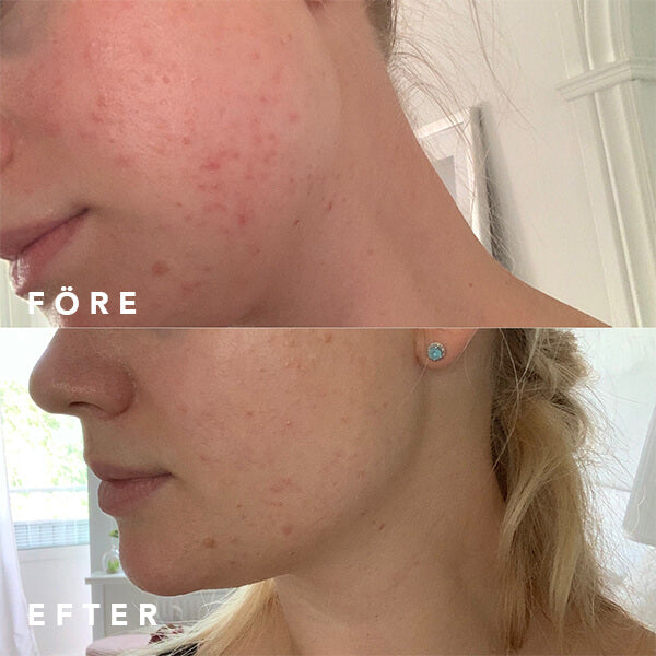 Före och efter resultat med Brilliant 10% Niacinamide + Zinc serum