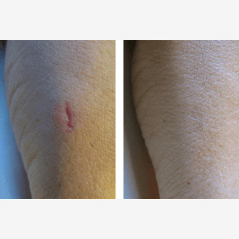 Cicamed Scar 15 g - Ärrbehandling