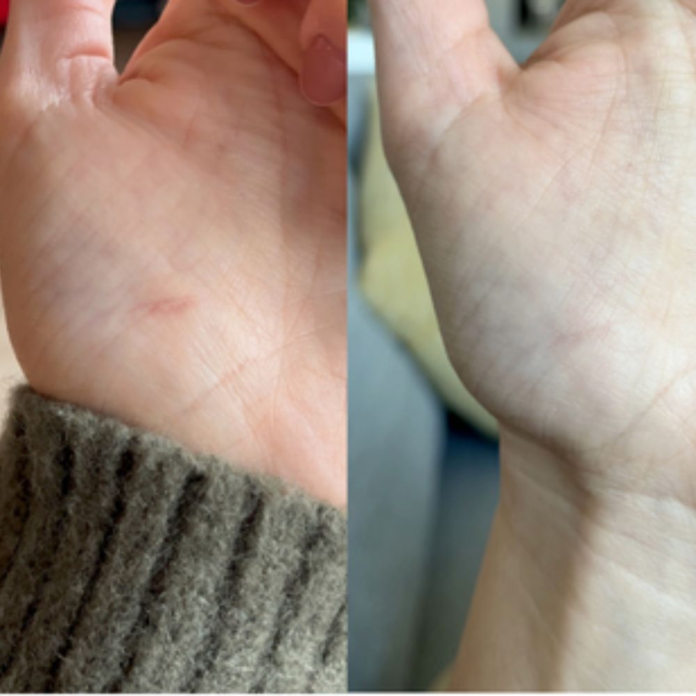 Cicamed Scar 15 g - Ärrbehandling