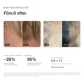 Före och efter 3 månader med Skinroller Hair Growth Kit – tätare hår och minskat håravfall