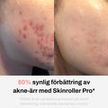 Skinroller PRO - Dermaroller