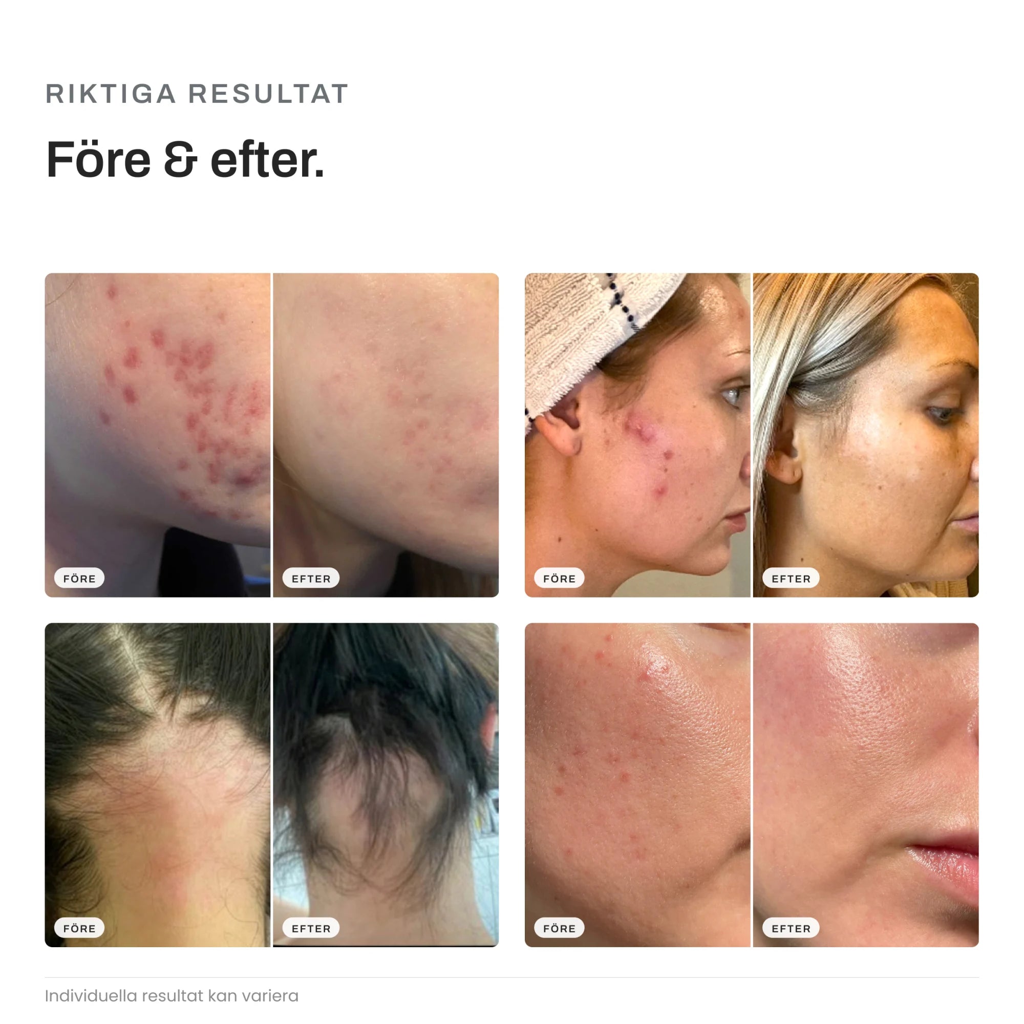 Image of Före och efter med Skinroller PRO dermaroller – fyra riktiga kundresultat på akneärr, rodnad, ojämn hudton och håravfall efter microneedling. Individuella resultat kan variera.