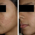 Skinroller PRO - Bristningar